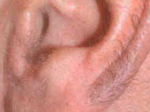 depilace3