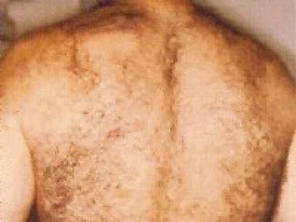 depilace7