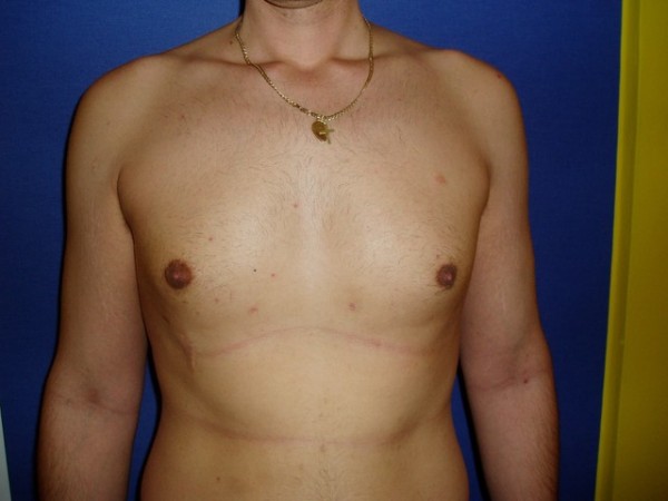 gynekomastie4