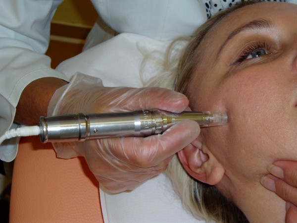 Microneedling1