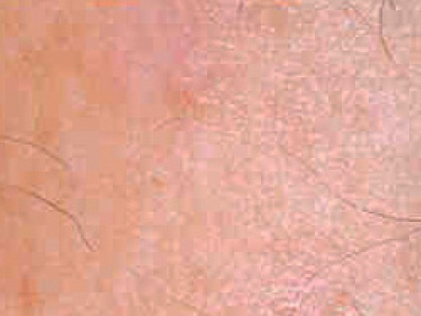 pigmentace10