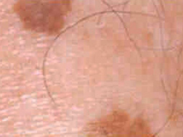 pigmentace9